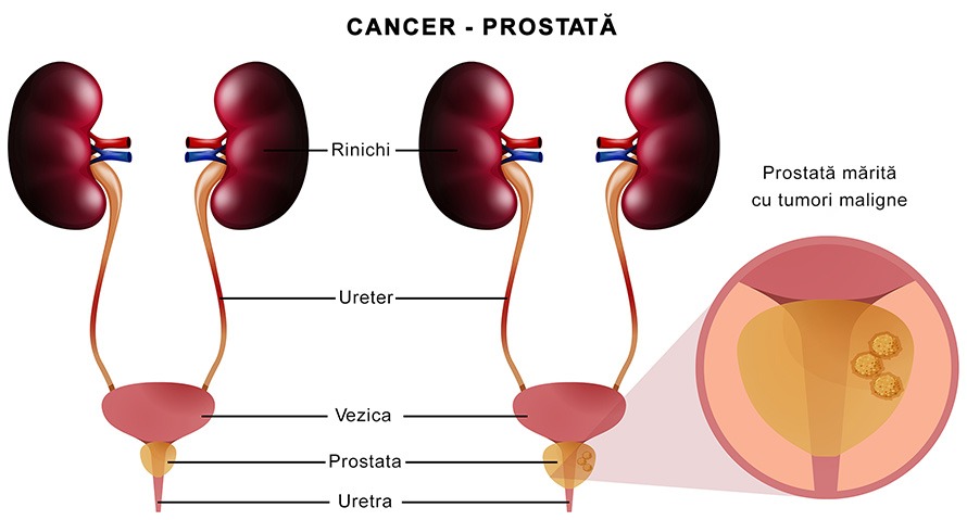 Cancer de prostată 2 Tratamentul cancerului de prostată